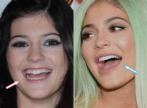 kylie jenner before and after teeth|kylie before and after.